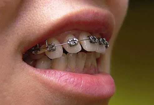 Close-up of an open mouth showing metal braces on the upper teeth