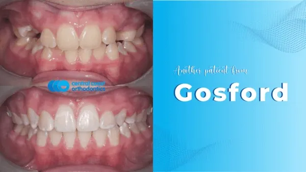 Before and after photographs of a Central Coast Orthodontics patient's teeth, labelled Gosford