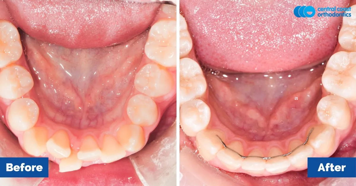 Before and after comparison, lower teeth viewed from above