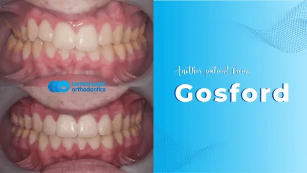 Before and after photographs of a Central Coast Orthodontics patient's teeth, labelled Gosford