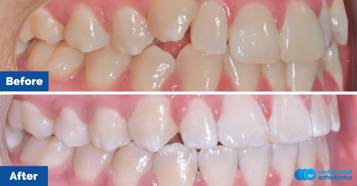 Before and after comparison, side view of the upper and lower teeth