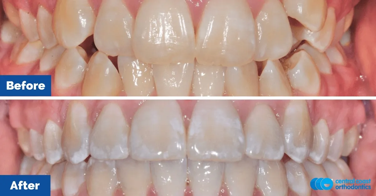 Before and after comparison, front view of the upper and lower teeth