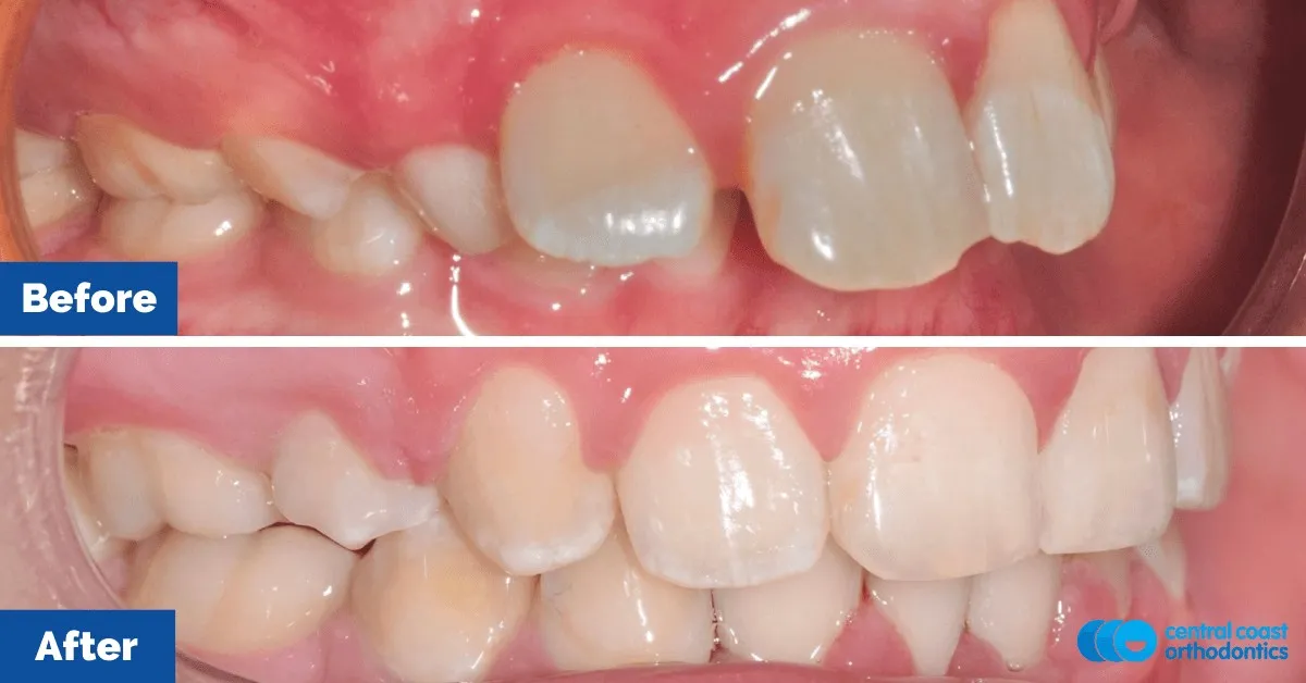 Before and after comparison, side view of the upper and lower teeth
