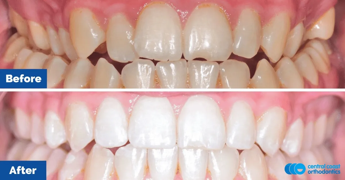 Before and after comparison, front view of the upper and lower teeth