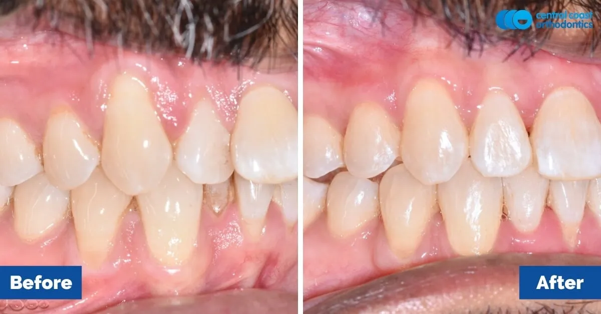 Before and after comparison, side view of the upper and lower teeth