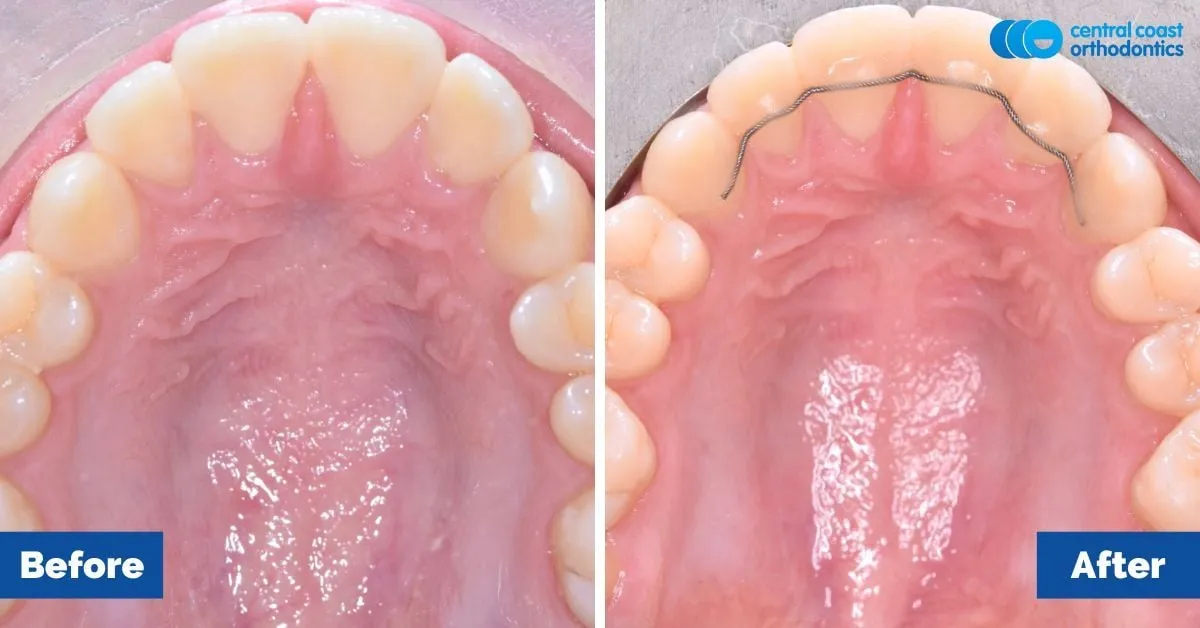 Before and after comparison, upper teeth viewed from below