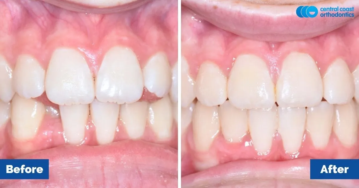 Before and after comparison, front view of the upper and lower teeth