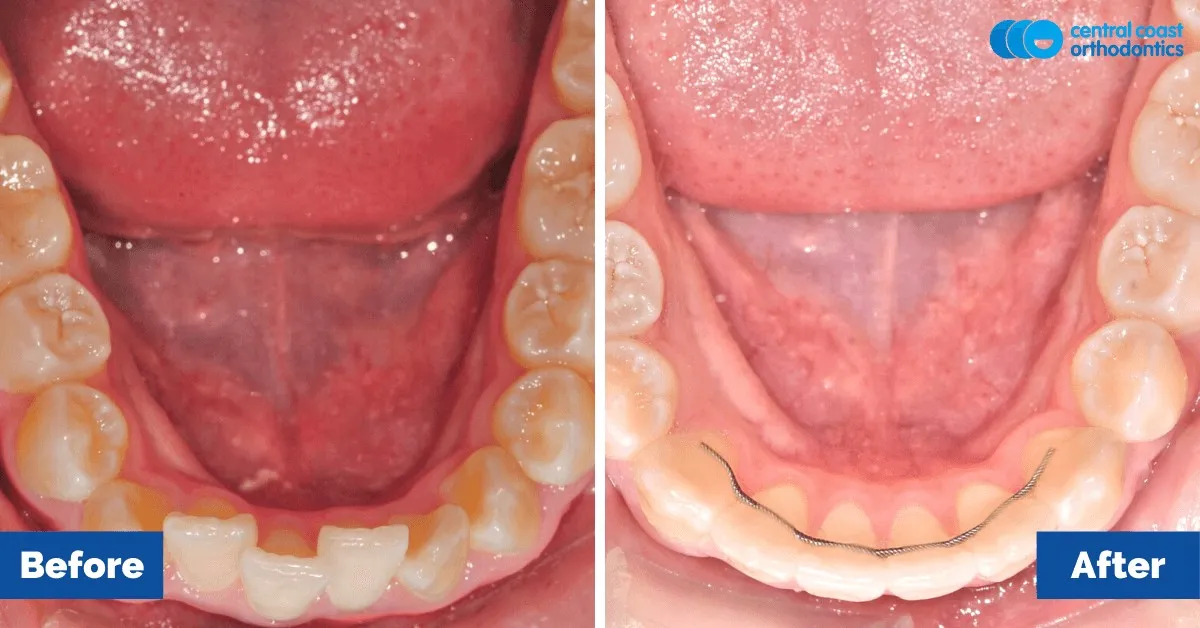 Before and after comparison, lower teeth viewed from above