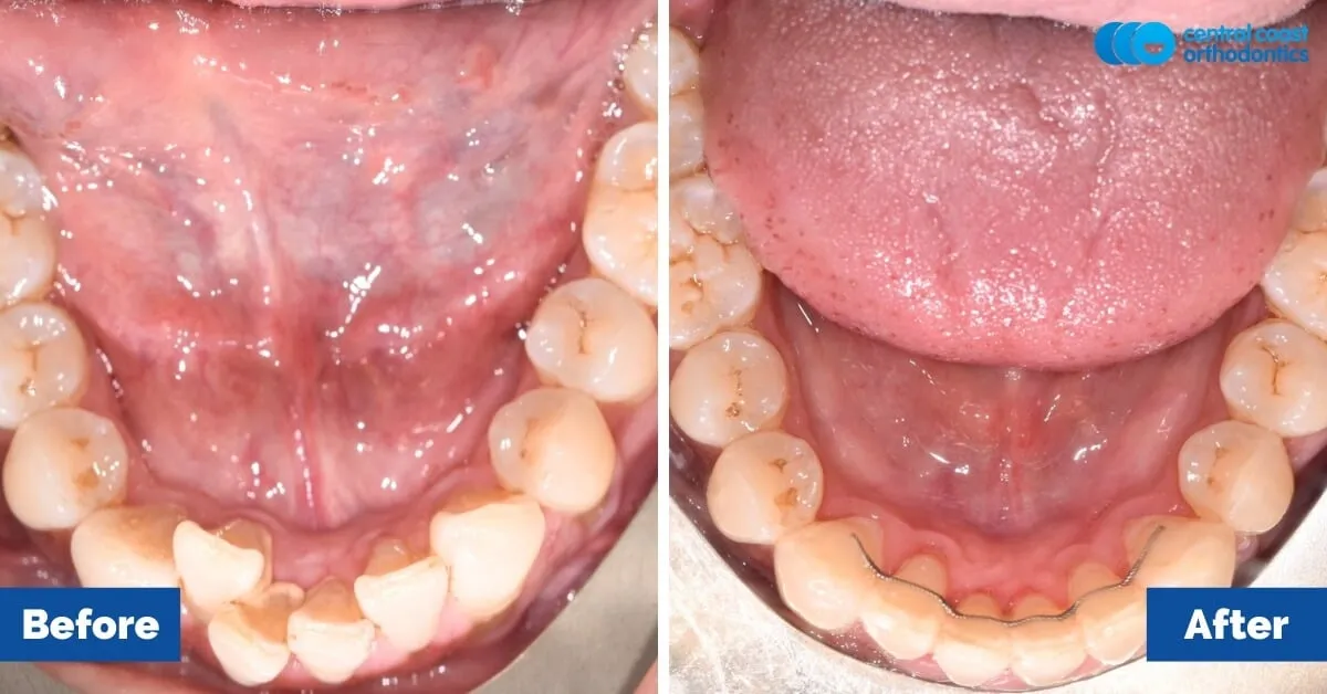 Before and after comparison, lower teeth viewed from above