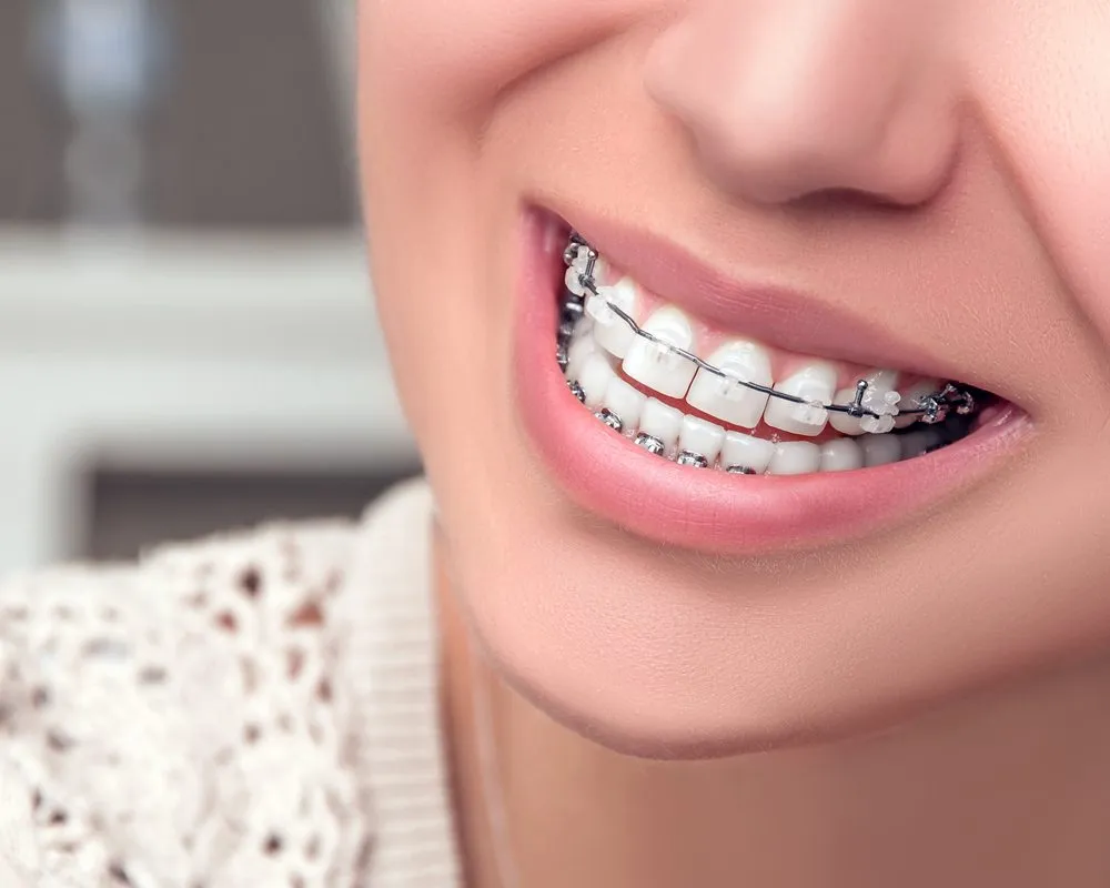 Close-up of a young woman smiling with metal braces on her upper and lower teeth