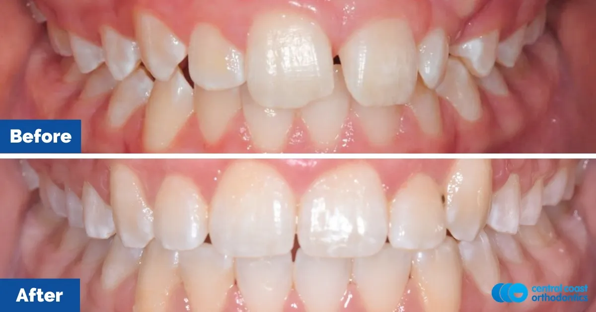 Before and after comparison, front view of the upper and lower teeth
