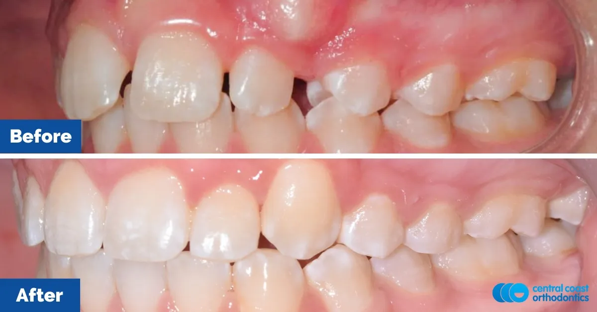 Before and after comparison, front view of the upper and lower teeth