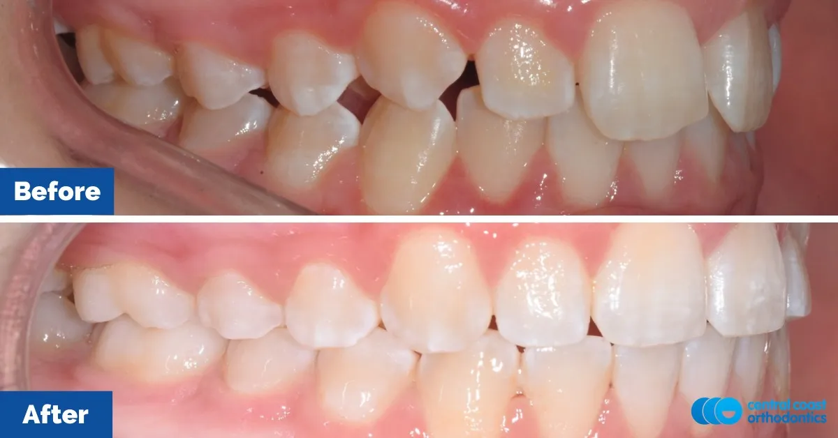 Before and after comparison, side view of the upper and lower teeth