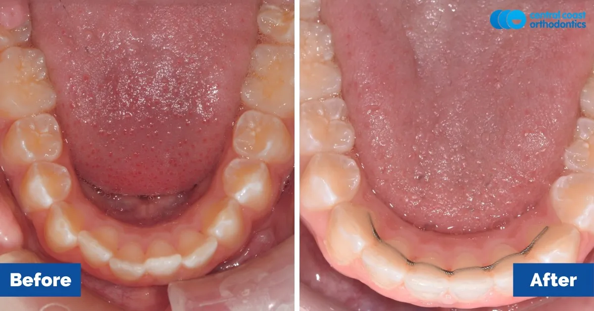 Before and after comparison, lower teeth viewed from above