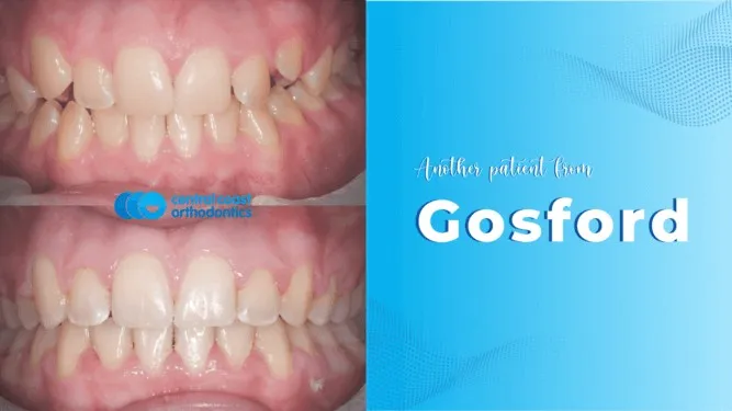 Before and after photographs of a Central Coast Orthodontics patient's teeth, labelled Gosford