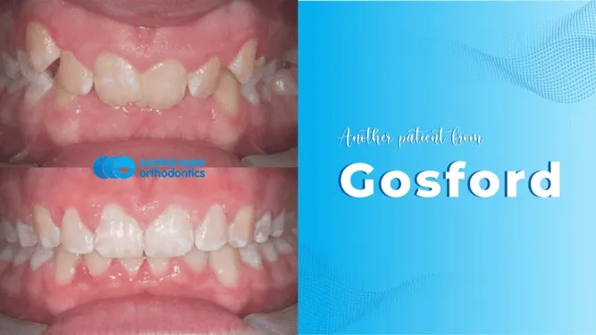 Before and after photographs of a Central Coast Orthodontics patient's teeth, labelled Gosford
