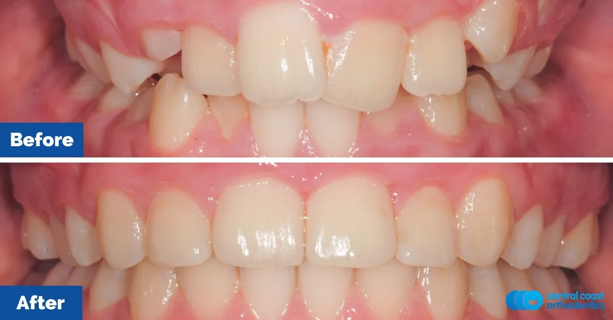 Before and after comparison, front view of the upper and lower teeth