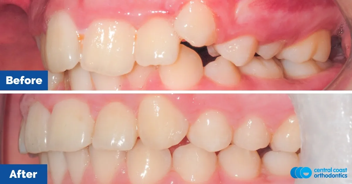 Before and after comparison, side view of the upper and lower teeth