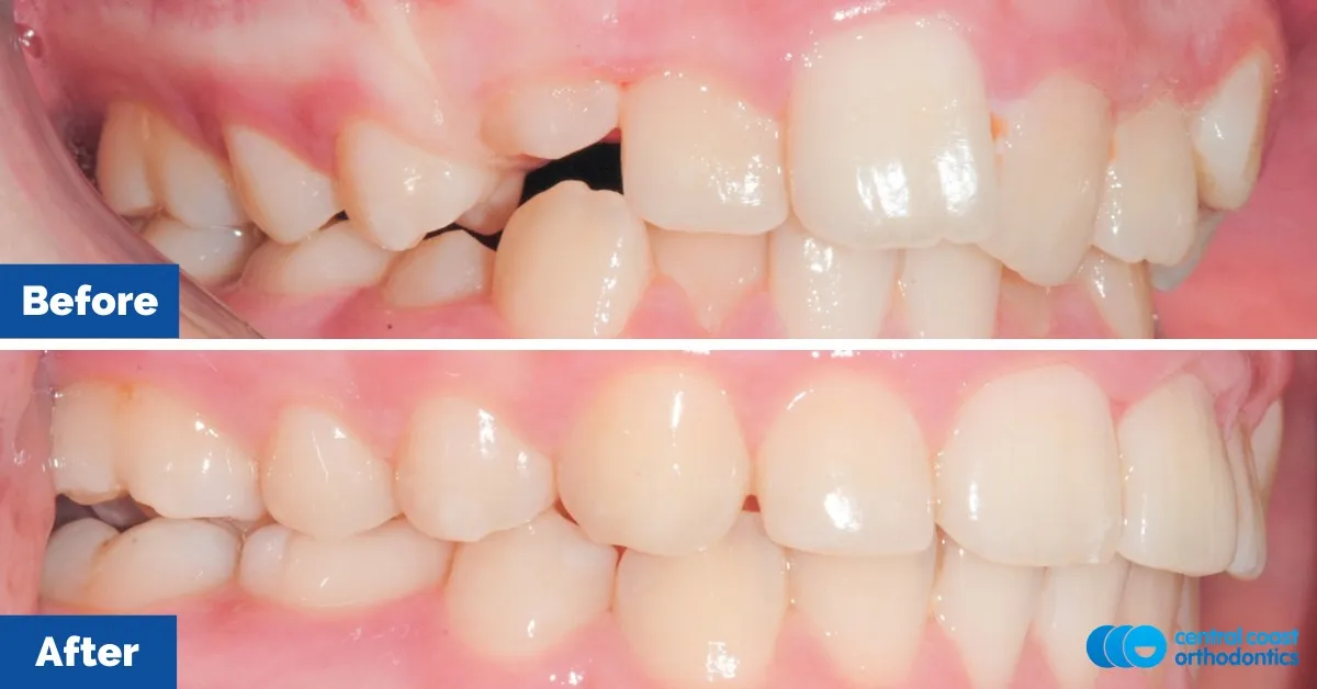 Before and after comparison, side view of the upper and lower teeth