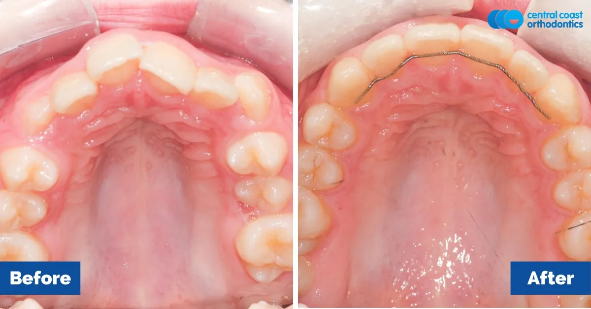 Before and after comparison, upper teeth viewed from below