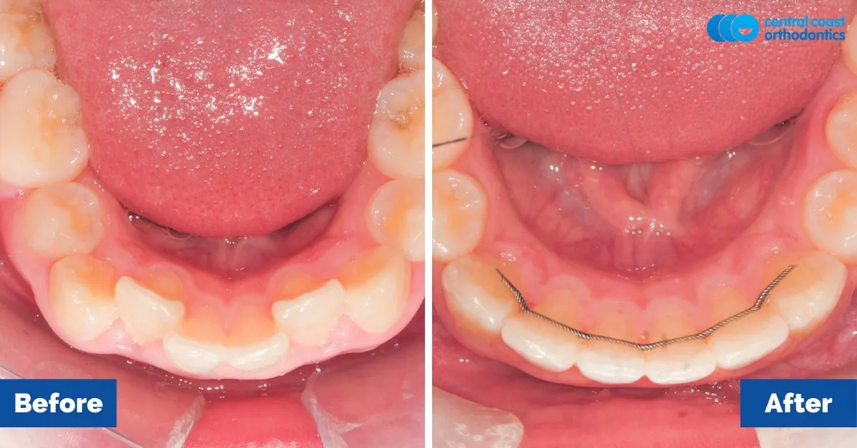 Before and after comparison, lower teeth viewed from above