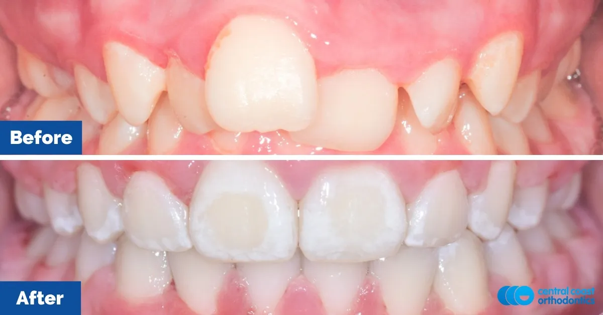 Before and after comparison, front view of the upper and lower teeth