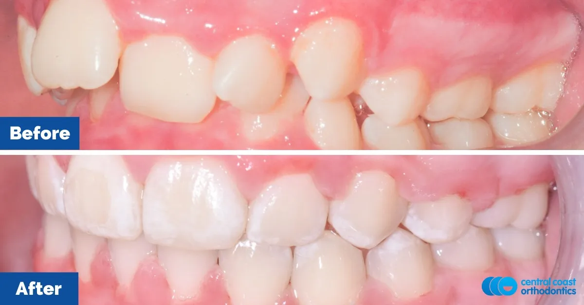 Before and after comparison, side view of the upper and lower teeth