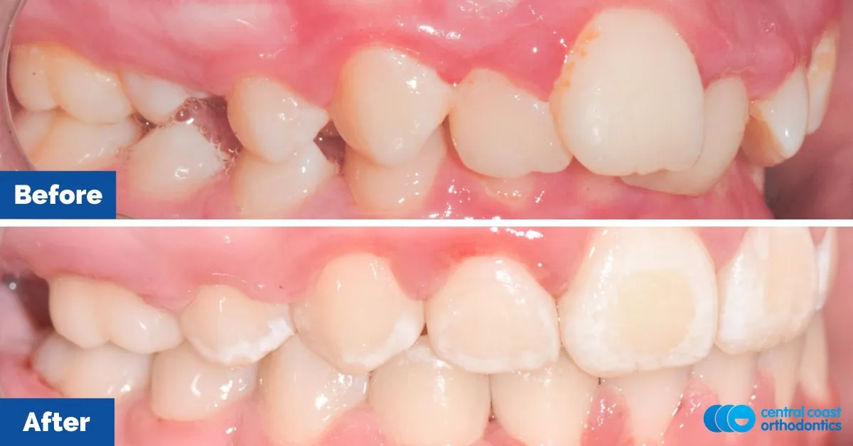 Before and after comparison, side view of the upper and lower teeth