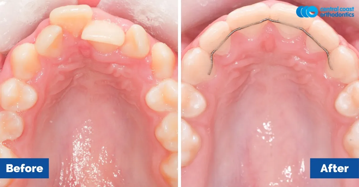 Before and after comparison, upper teeth viewed from below