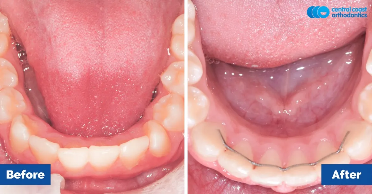 Before and after comparison, lower teeth viewed from above