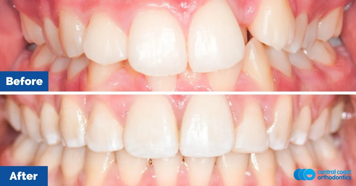 Before and after comparison, front view of the upper and lower teeth