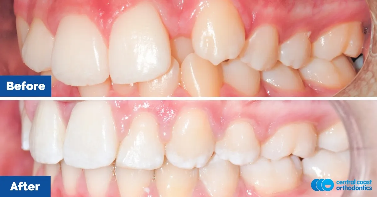 Before and after comparison, side view of the upper and lower teeth