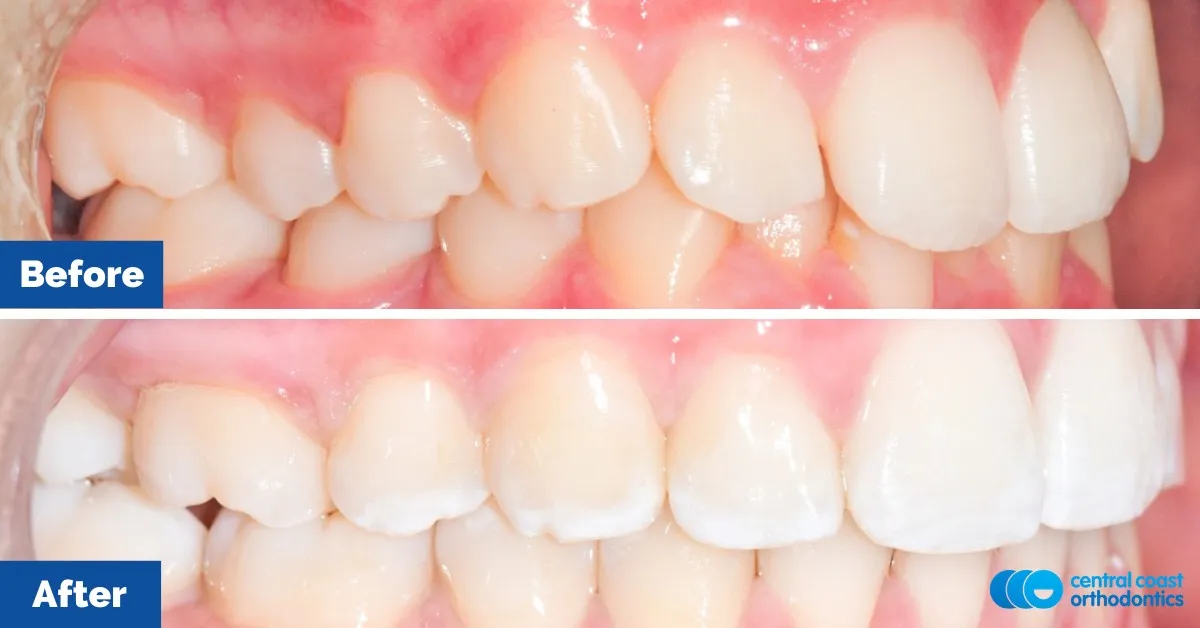 Before and after comparison, front view of the upper and lower teeth