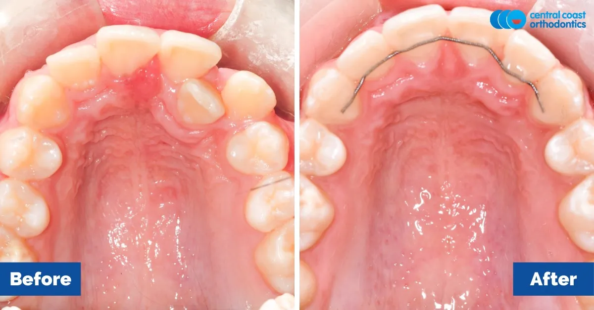 Before and after comparison, upper teeth viewed from below