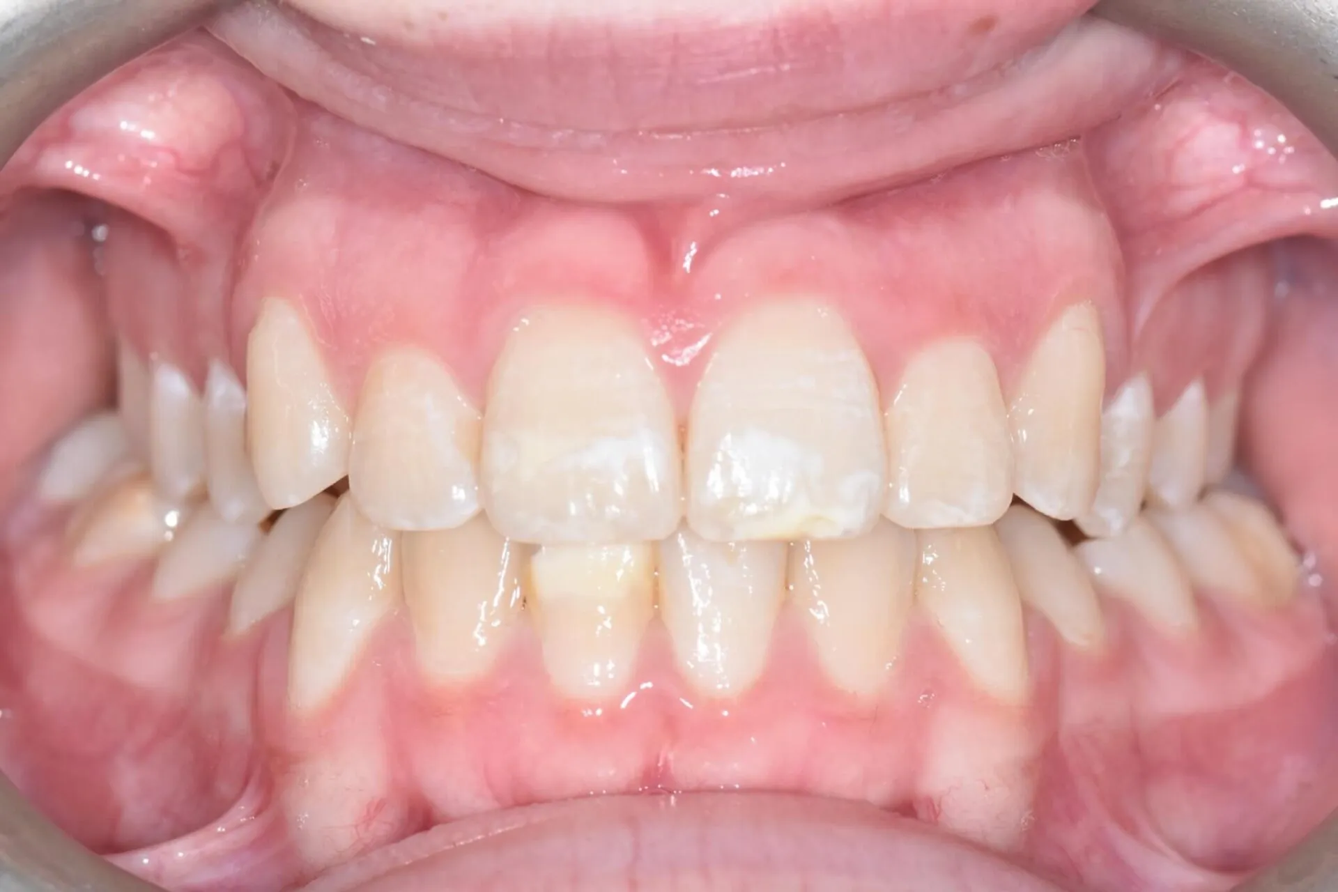 Close-up of a patient's evenly aligned upper and lower teeth after orthodontic treatment