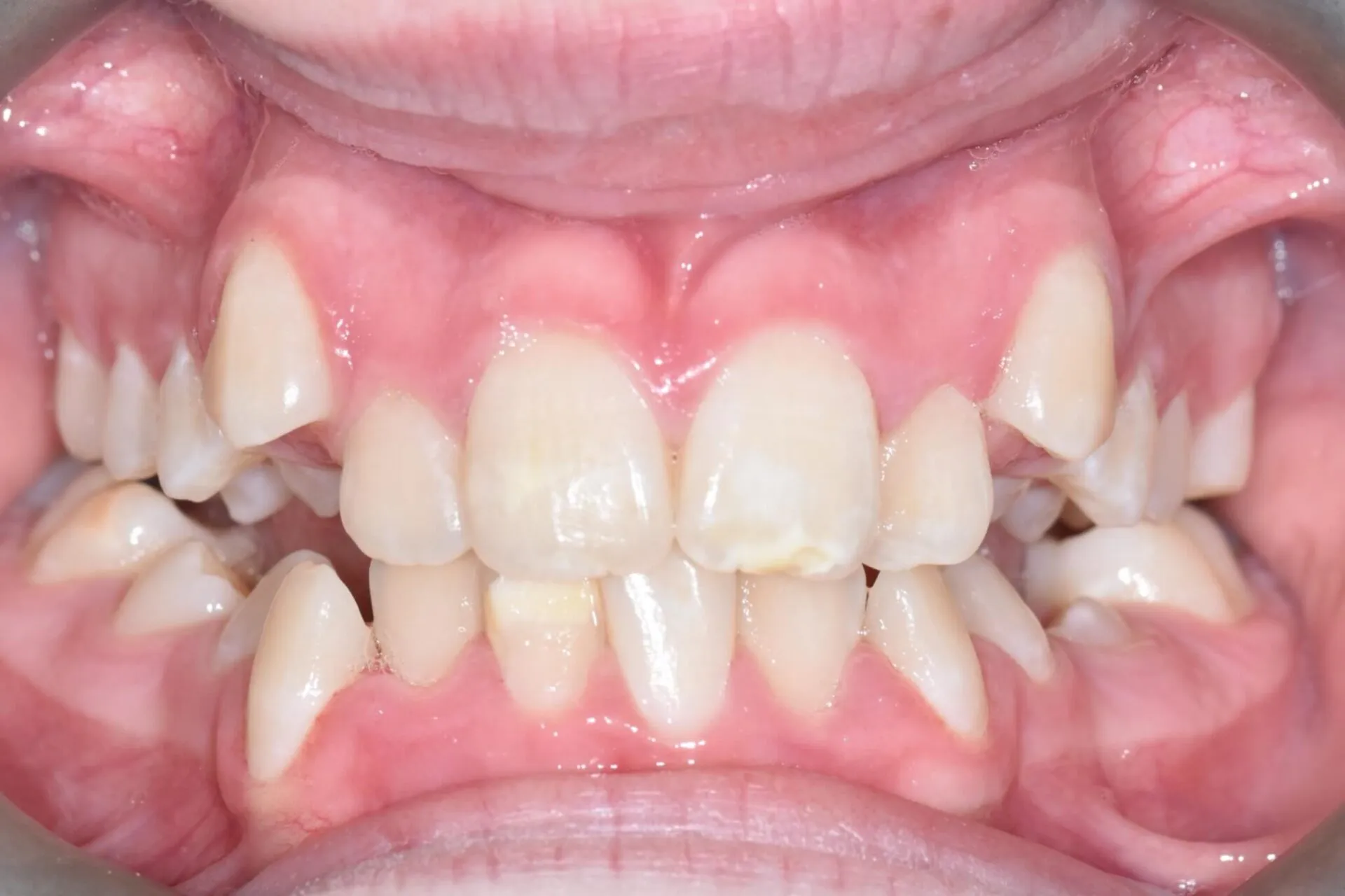 Close-up of crowded and rotated upper front teeth before orthodontic treatment
