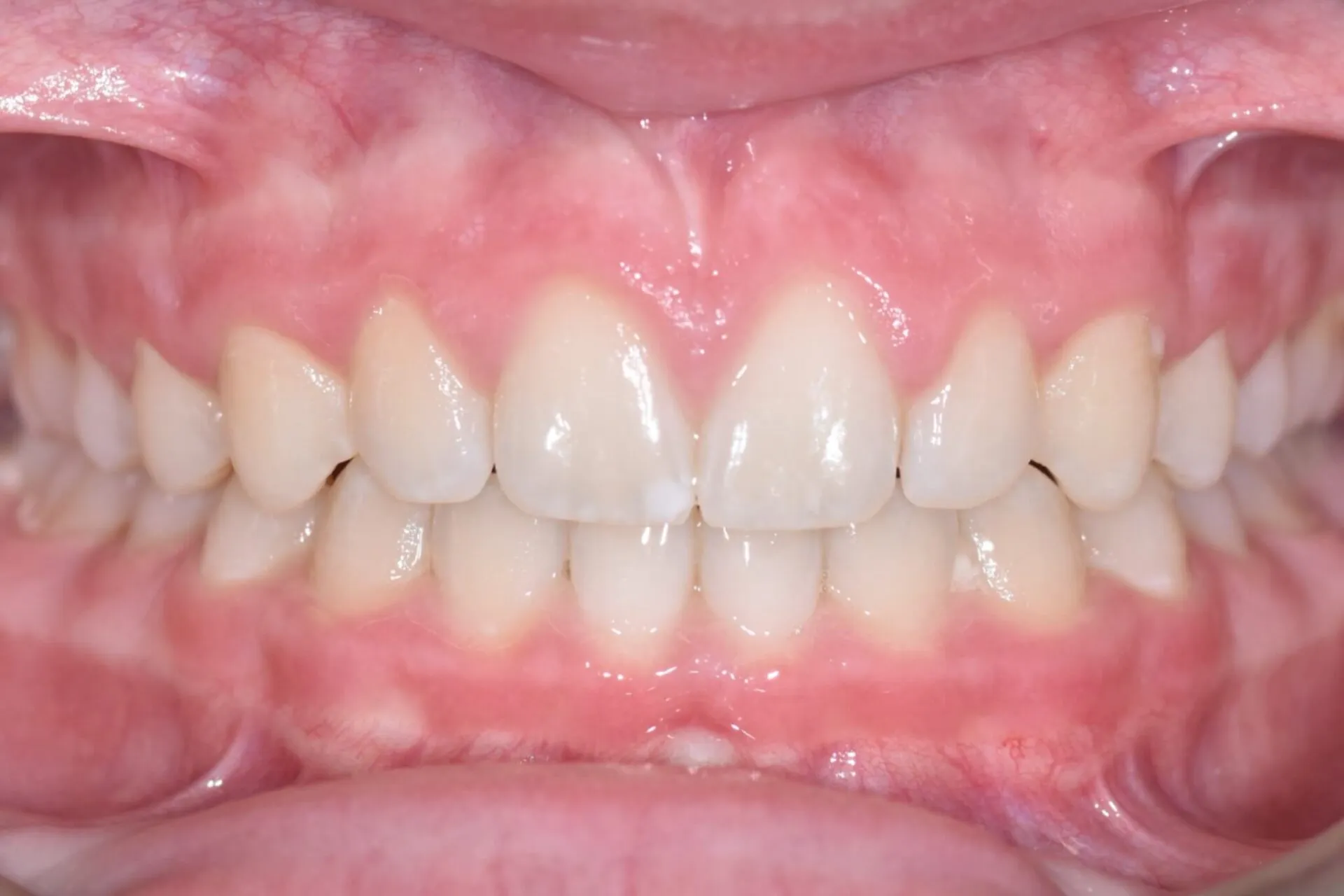 The same patient's upper and lower front teeth aligned after orthodontic treatment
