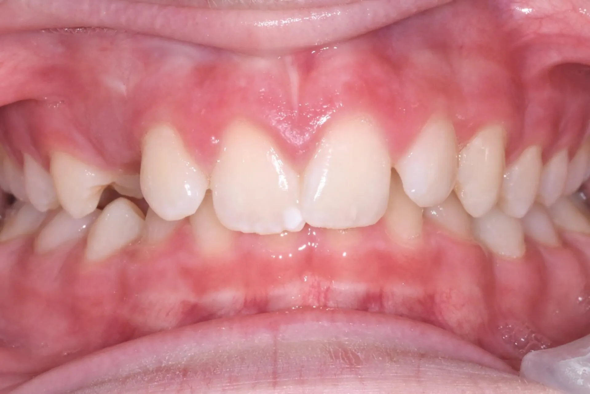 Close-up of crowded upper and lower front teeth before orthodontic treatment