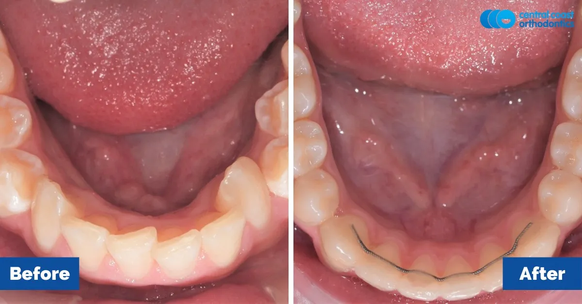 Before and after comparison, lower teeth viewed from above