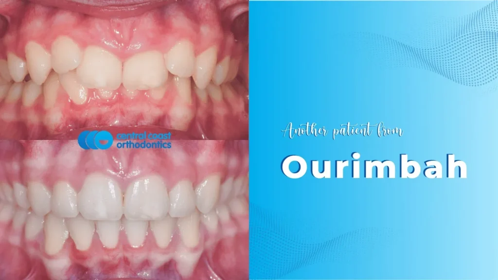 Before and after photographs of a Central Coast Orthodontics patient's teeth, labelled Ourimbah