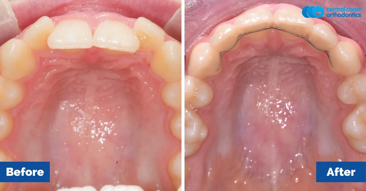 Before and after comparison, upper teeth viewed from below