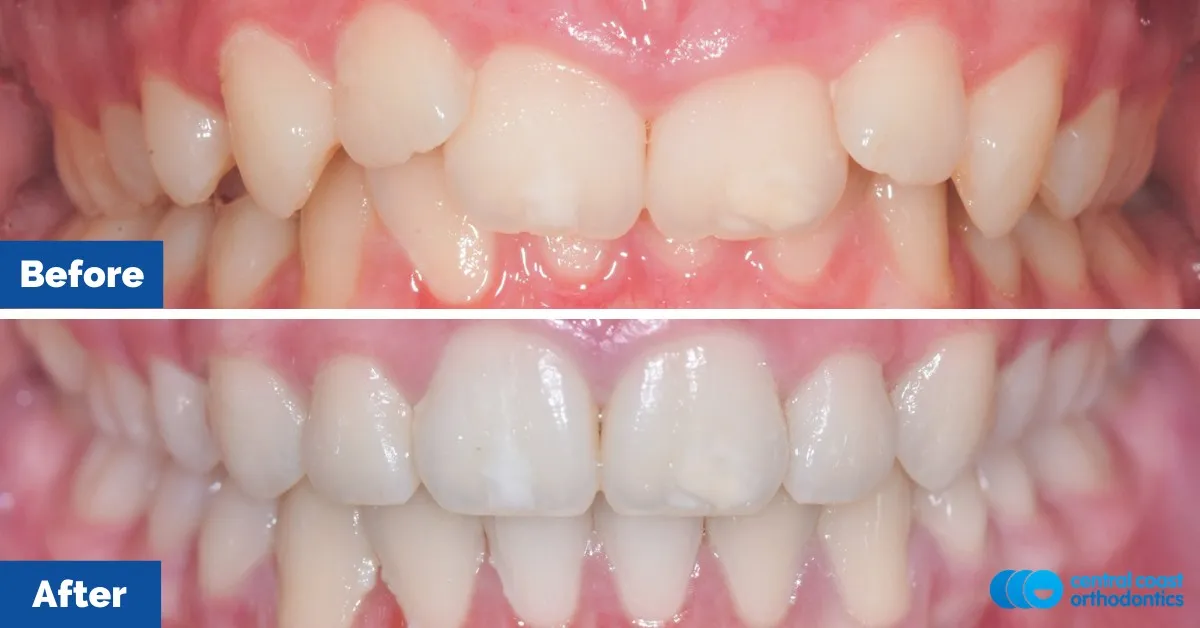 Before and after comparison, front view of the upper and lower teeth