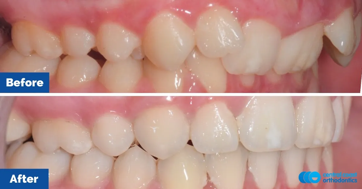 Before and after comparison, side view of the upper and lower teeth