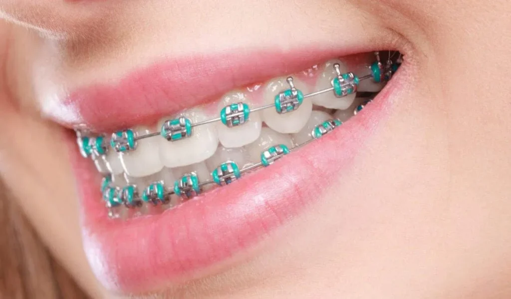 Close-up of a smile with metal braces and blue elastic ties