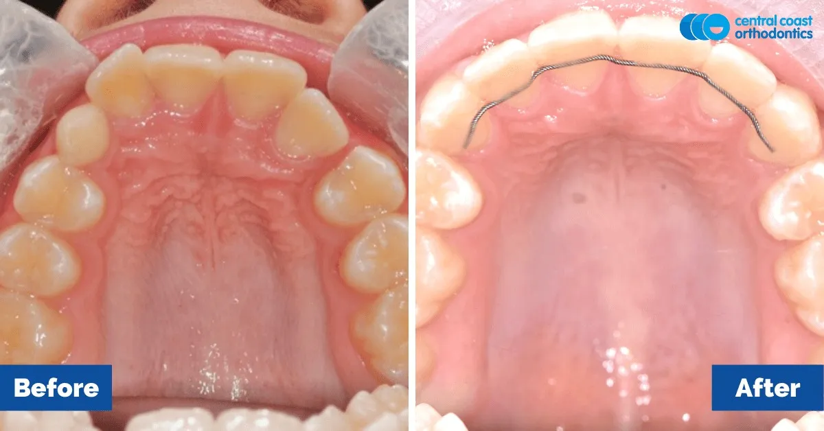 Before and after comparison, upper teeth viewed from below