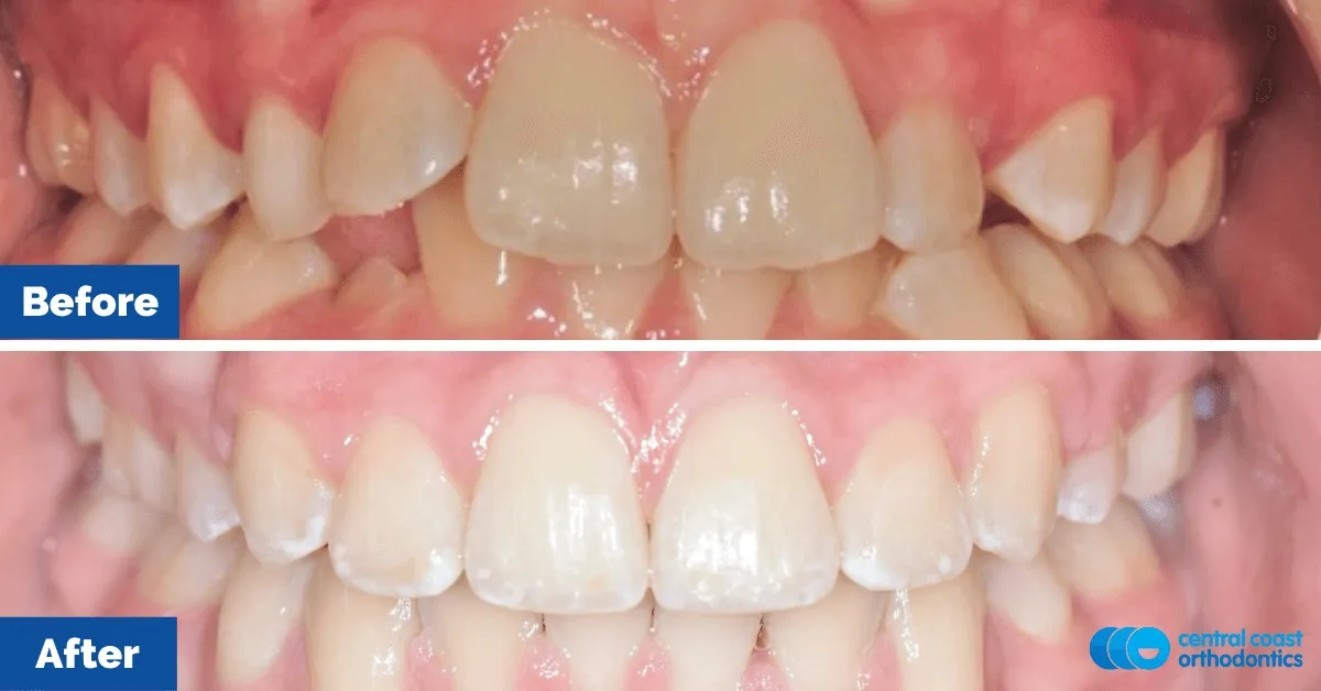 Before and after comparison, front view of the upper and lower teeth