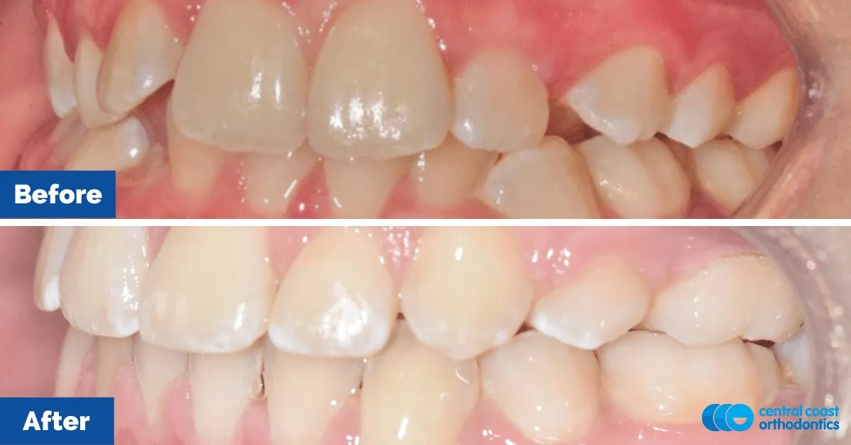 Before and after comparison, side view of the upper and lower teeth