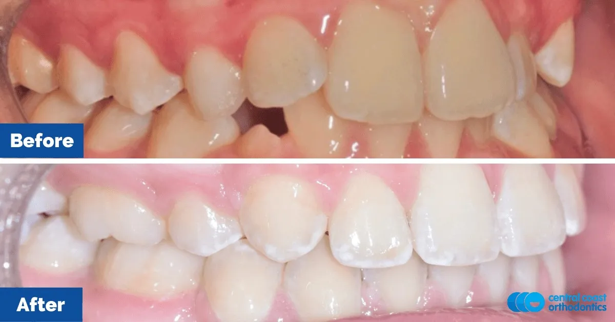 Before and after comparison, front view of the upper and lower teeth