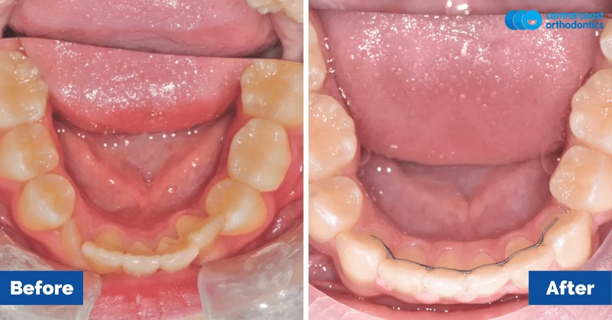 Before and after comparison, lower teeth viewed from above