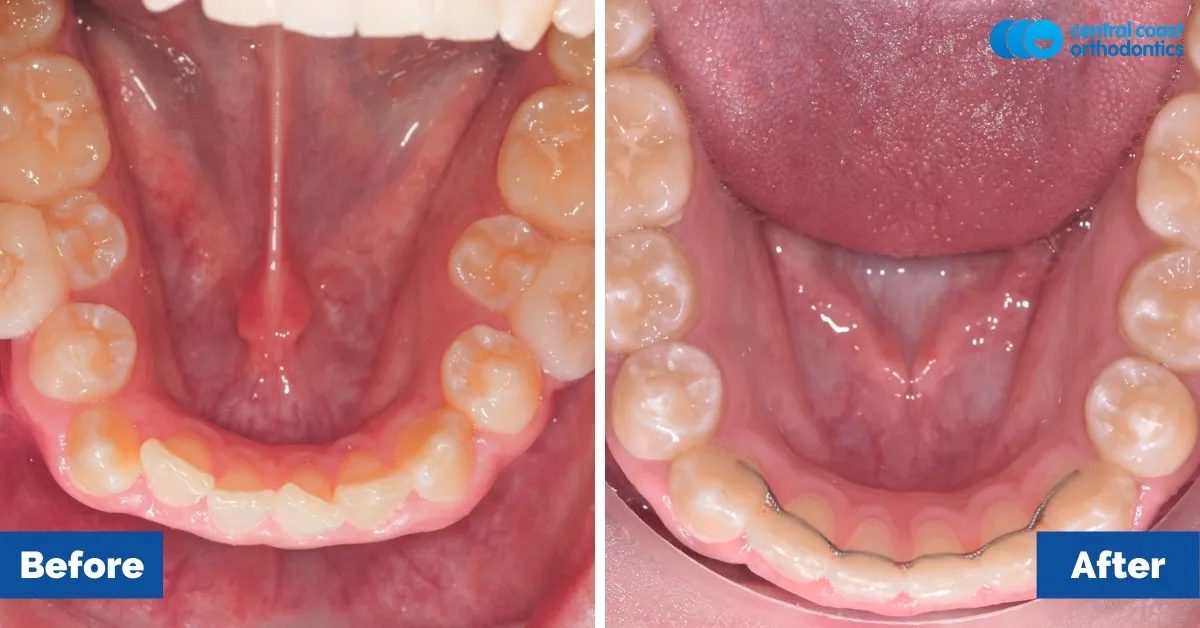 Before and after comparison, lower teeth viewed from above